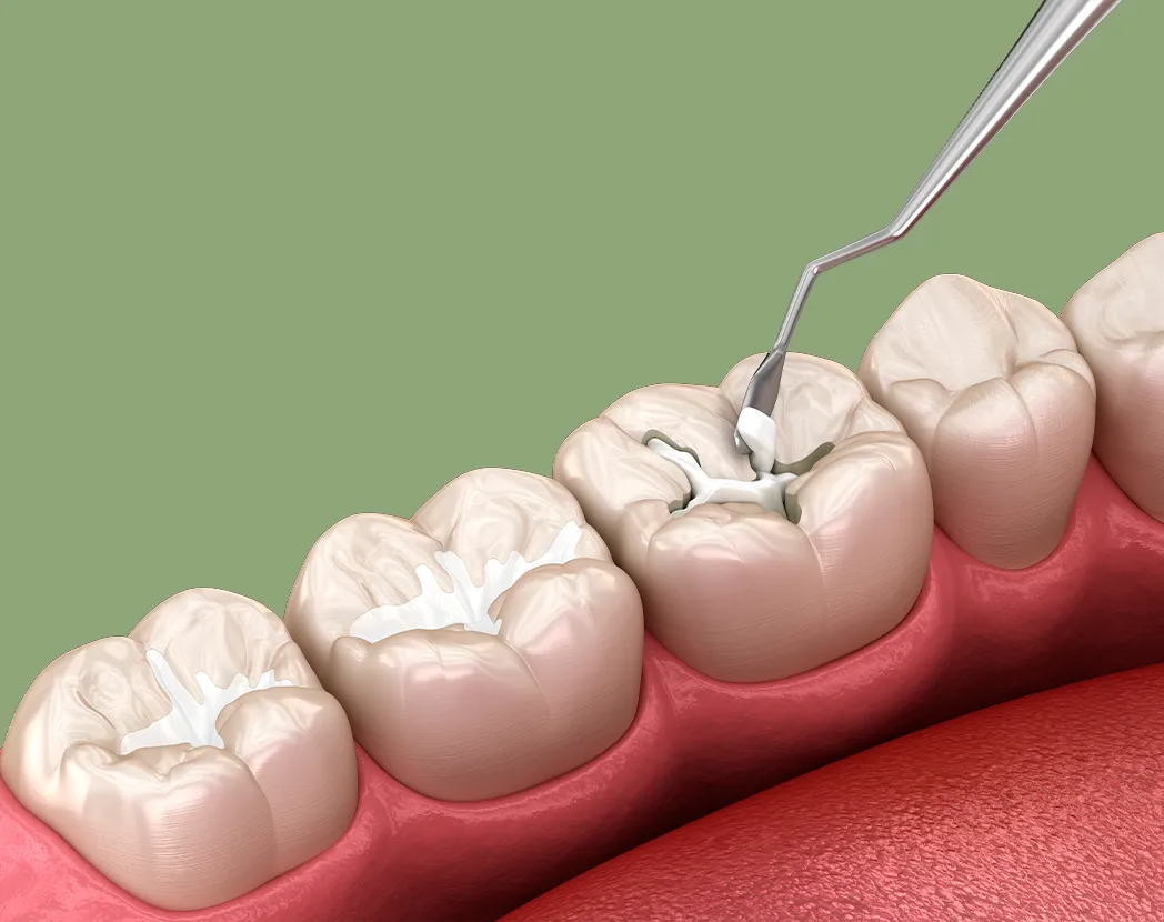 Çocuklarda Koruyucu Diş Tedavileri Noedent Ağız ve Diş Sağlığı Polikliniği