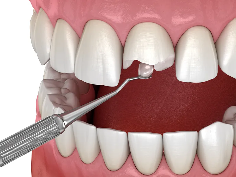 Kompozit Bonding Tedavisi Mustafa Kemal Mahallesi, Kompozit Bonding Tedavisi Söğütözü, Kompozit Bonding Tedavisi Bilkent, Kompozit Bonding Tedavisi Çukurambar, Kompozit Bonding Tedavisi Çayyolu, Noedent Maidan Diş Kliniği