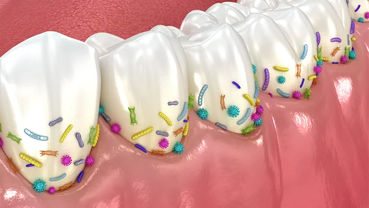 Gingivitis Nedir , diş eti hastalığı , Gingivitis , diş eti hastalığı Bilkent , Gingivitis , diş eti hastalığı Mustafa Kemal Mahallesi ,Gingivitis , diş eti hastalığı Çukurambar , Gingivitis , diş eti hastalığı Çayyolu Noedent Maidan Diş Kliniği