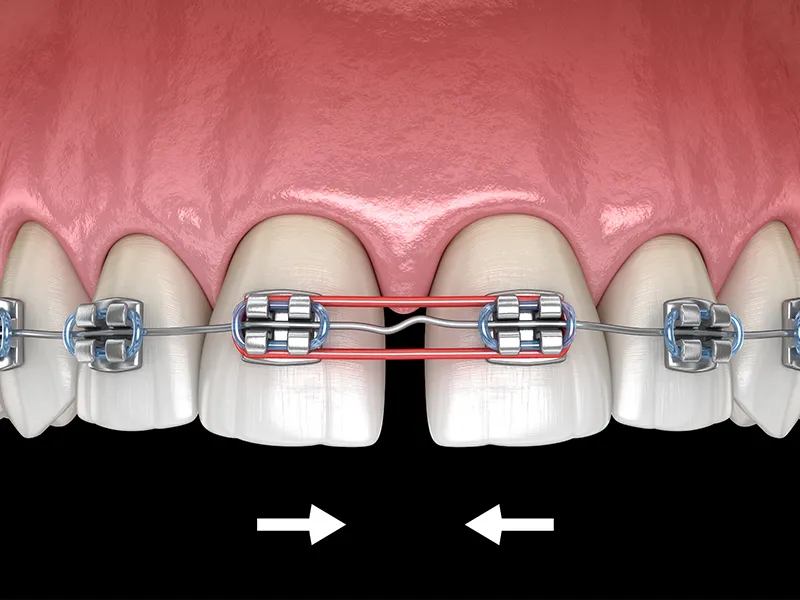 Ortodonti Lastiği , Ortodonti Lastiği Nedir , Mustafa Kemal Mahallesi , Noedent , Maidan Diş Kliniği
