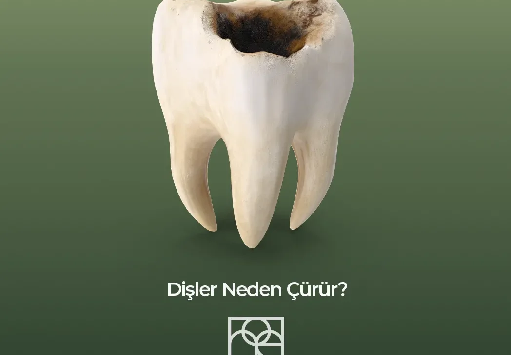 Dişler Neden Çürür? Ankara , Dişler Neden Çürür? Bilkent , Dişler Neden Çürür? Söğütözü, Dişler Neden Çürür? Mustafa Kemal Mahallesi , Dişler Neden Çürür? Çukurambar, Dişler Neden Çürür? Çayyolu - Özlem Nasibe Bayazıt, Ortodonti Uzmanı Mustafa Kemal Mahallesi, Ortodonti Uzmanı Bilkent , Ortodonti Uzmanı Söğütözü, Ortodonti Uzmanı Mahall Ankara , Çocuk Diş Hekimi Ela Öner Aytar Bilkent, Çocuk Diş Hekimi Ela Öner Aytar Çayyolu, Çocuk Diş Hekimi Ela Öner Aytar Mustafa Kemal, Çocuk Diş Hekimi Ela Öner Aytar Söğütözü,