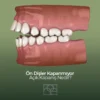 Ön dişler kapanmıyor , açoık kapanış, Noedent Diş Kliniği , Maidan Diş Kliniği , Bilkent diş kliniği