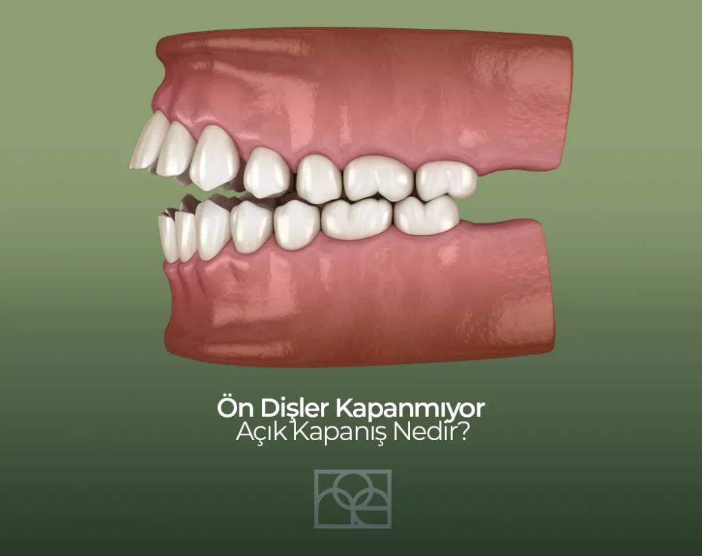 Ön dişler kapanmıyor , açık kapanış, Noedent Diş Kliniği , Maidan Diş Kliniği , Bilkent diş kliniği