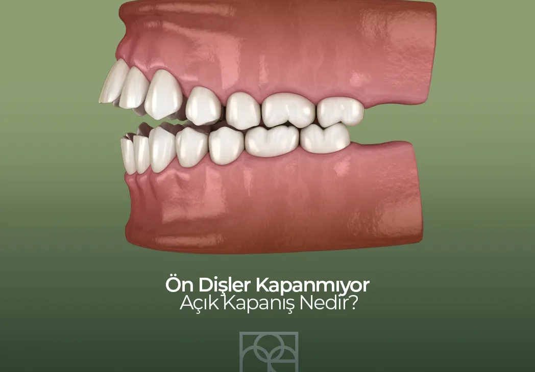 Ön dişler kapanmıyor , açoık kapanış, Noedent Diş Kliniği , Maidan Diş Kliniği , Bilkent diş kliniği