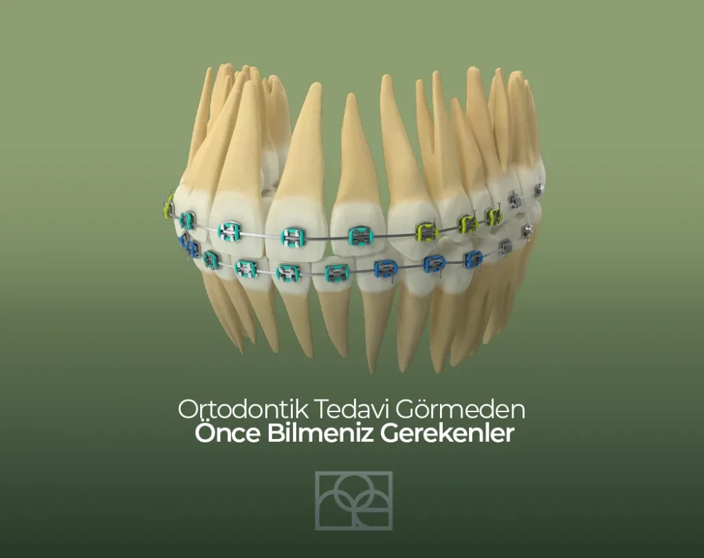 Ortodontik Tedavi Görmeden Önce Bilmeniz Gerekenler