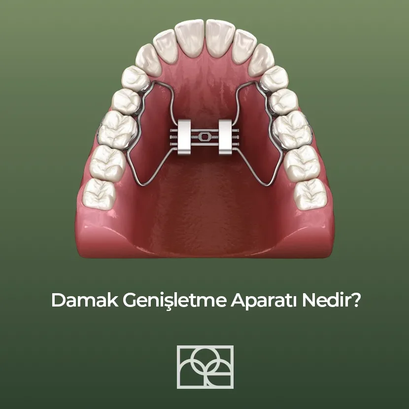 Damak Genişletme Aparatı