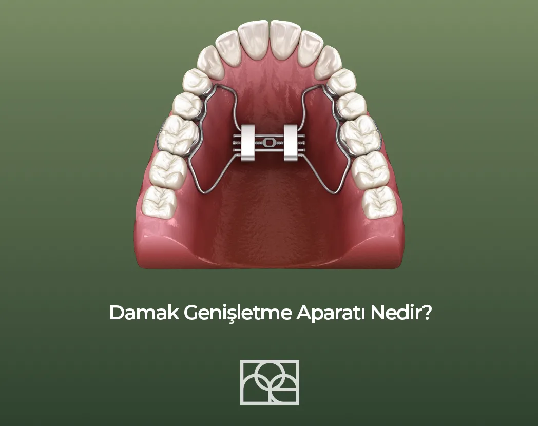 Damak Genişletme Aparatı