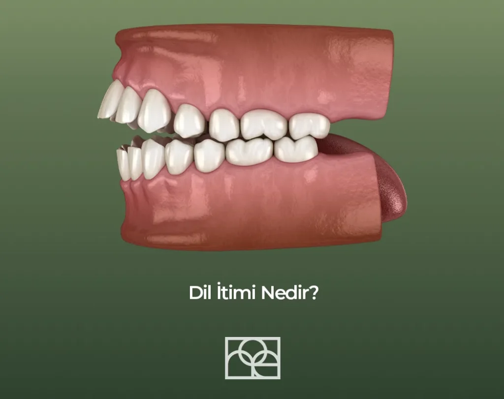 Dil İtimi Nedir ,Noedent Diş Kliniği , Maidan Diş Kliniği , Bilkent diş kliniği