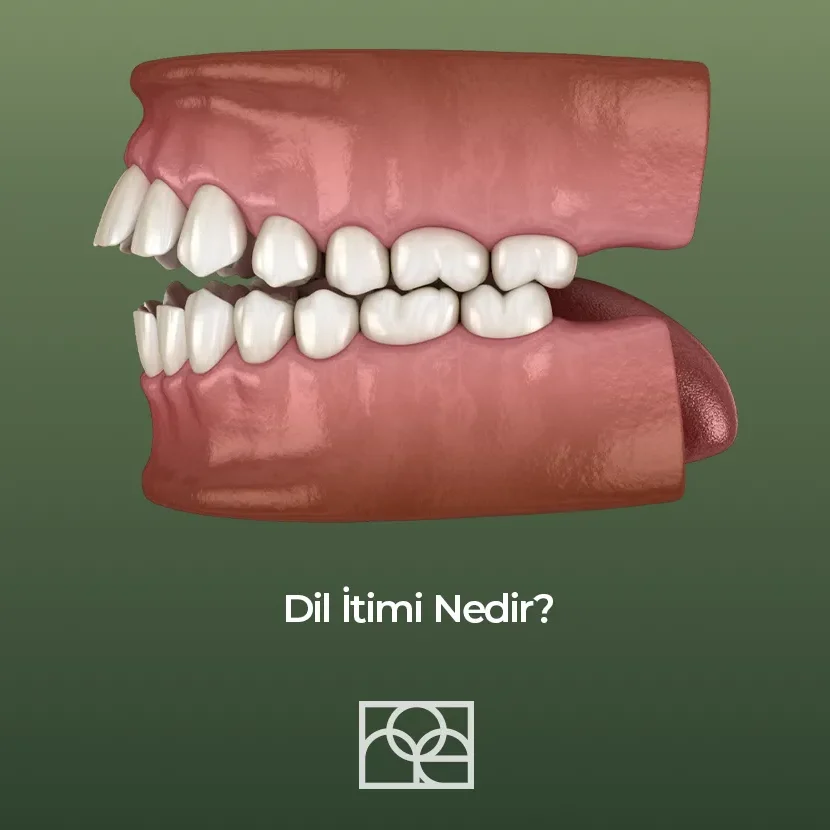 Dil İtimi Nedir ,Noedent Diş Kliniği , Maidan Diş Kliniği , Bilkent diş kliniği