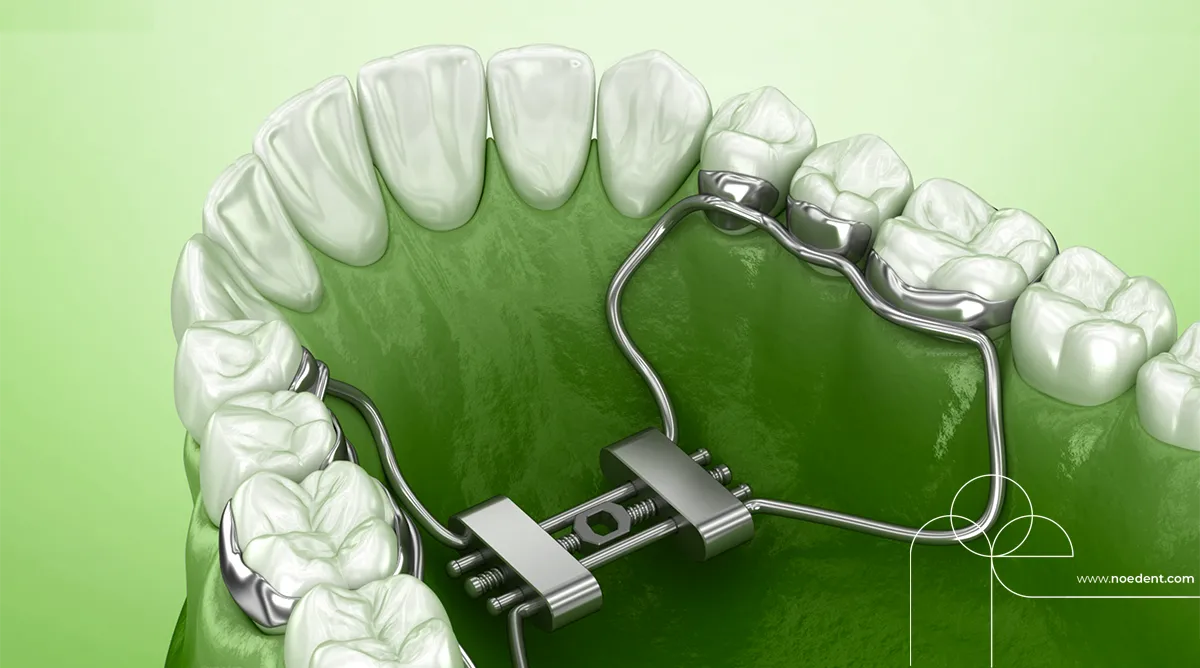 Damak Genişletme Aparatı , Damak Darlığı , çene ortopedisi , üst çene genişletme, Ankara Ortodonti , Bilkent Ortodonti , Ortodontist