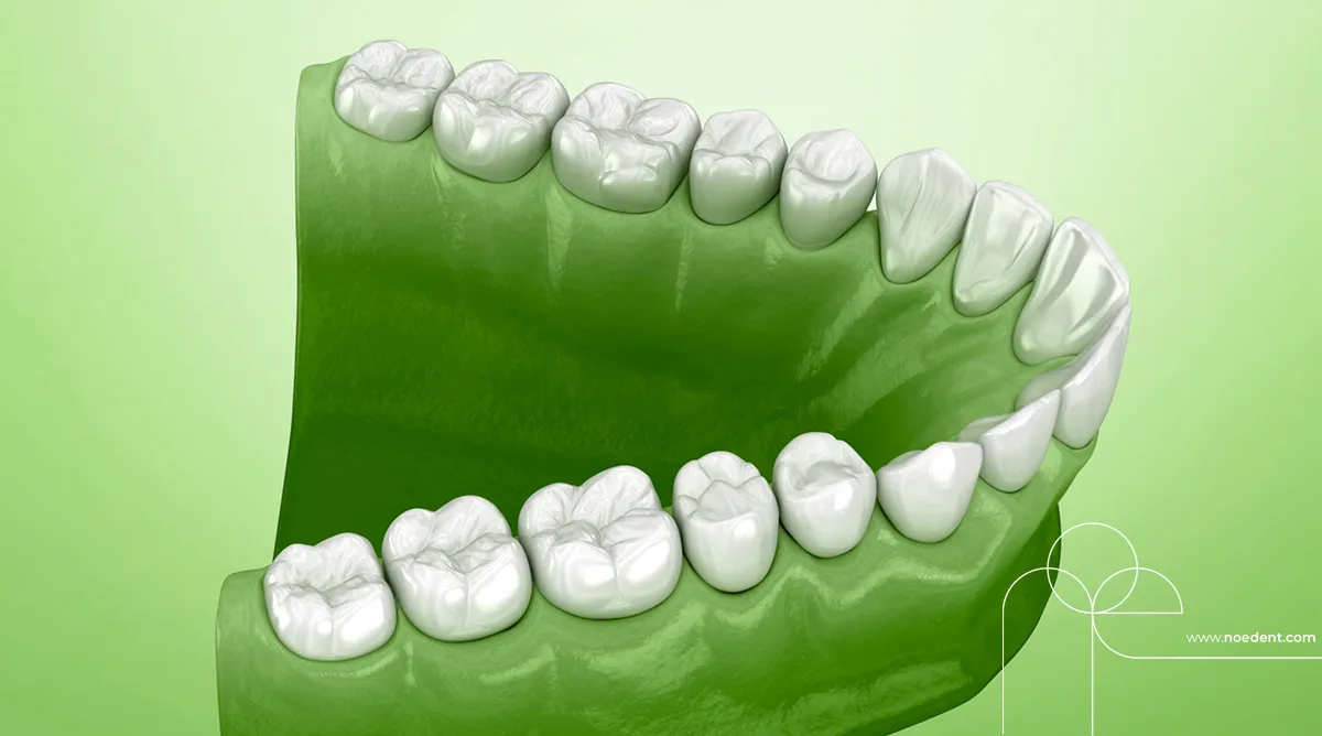 Damak Genişletme Aparatı , Damak Darlığı , çene ortopedisi , üst çene genişletme, Ankara Ortodonti , Bilkent Ortodonti , Ortodontist