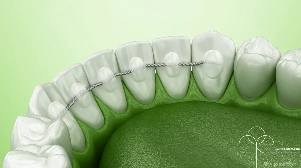 Ortodontide Pekiştirme Tedavisi , ortodonti bilkent , ortodonti çankaya , ortodontist çankaya , Noedent Diş Kliniği