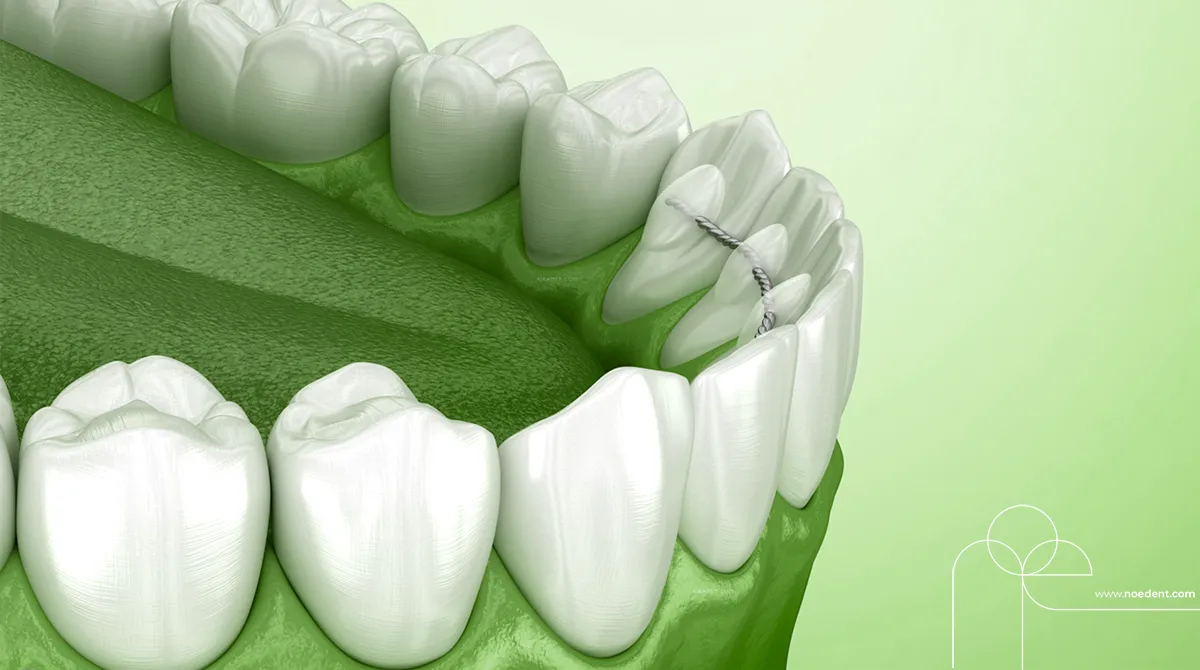 Ortodontide Pekiştirme Tedavisi , ortodonti bilkent , ortodonti çankaya , ortodontist çankaya , Noedent Diş Kliniği