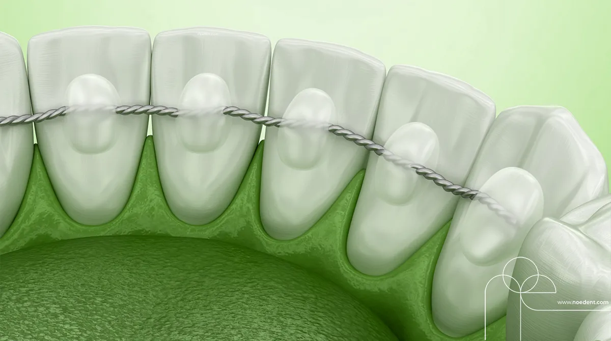 Ortodontide Pekiştirme Tedavisi , ortodonti bilkent , ortodonti çankaya , ortodontist çankaya , Noedent Diş Kliniği