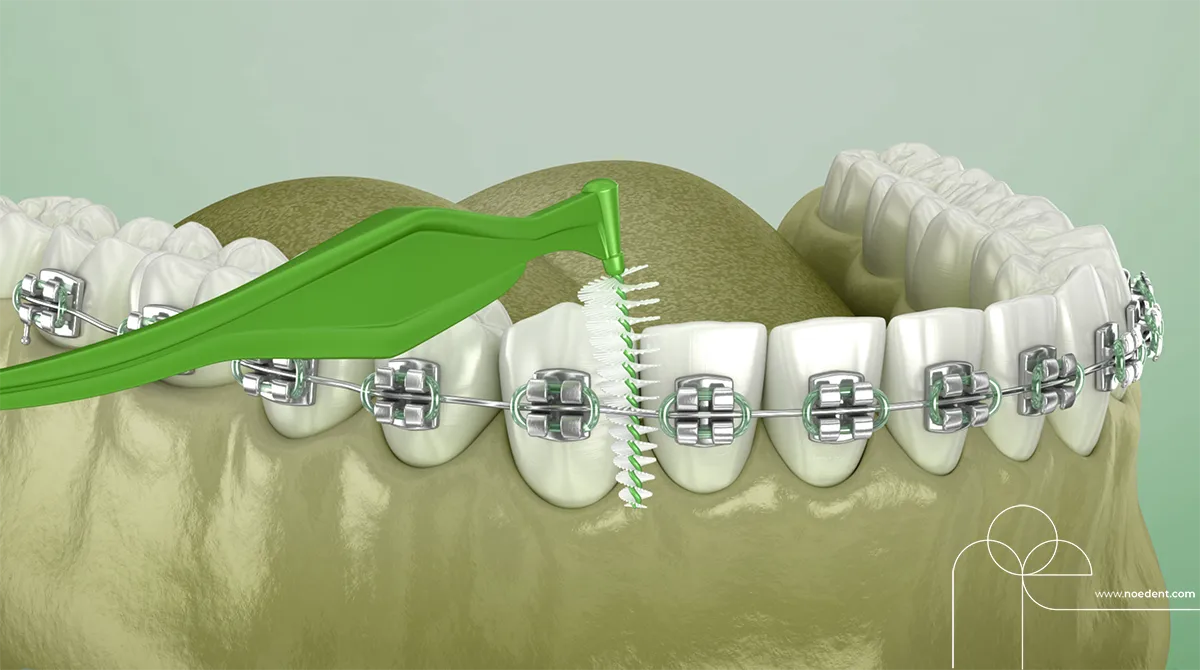 Ortodontik Ağız Bakımı , ortodontide ağız bakımı , ortodonti bilkent , ortodonti çankaya , ortodontist çankaya , Noedent Diş Kliniği