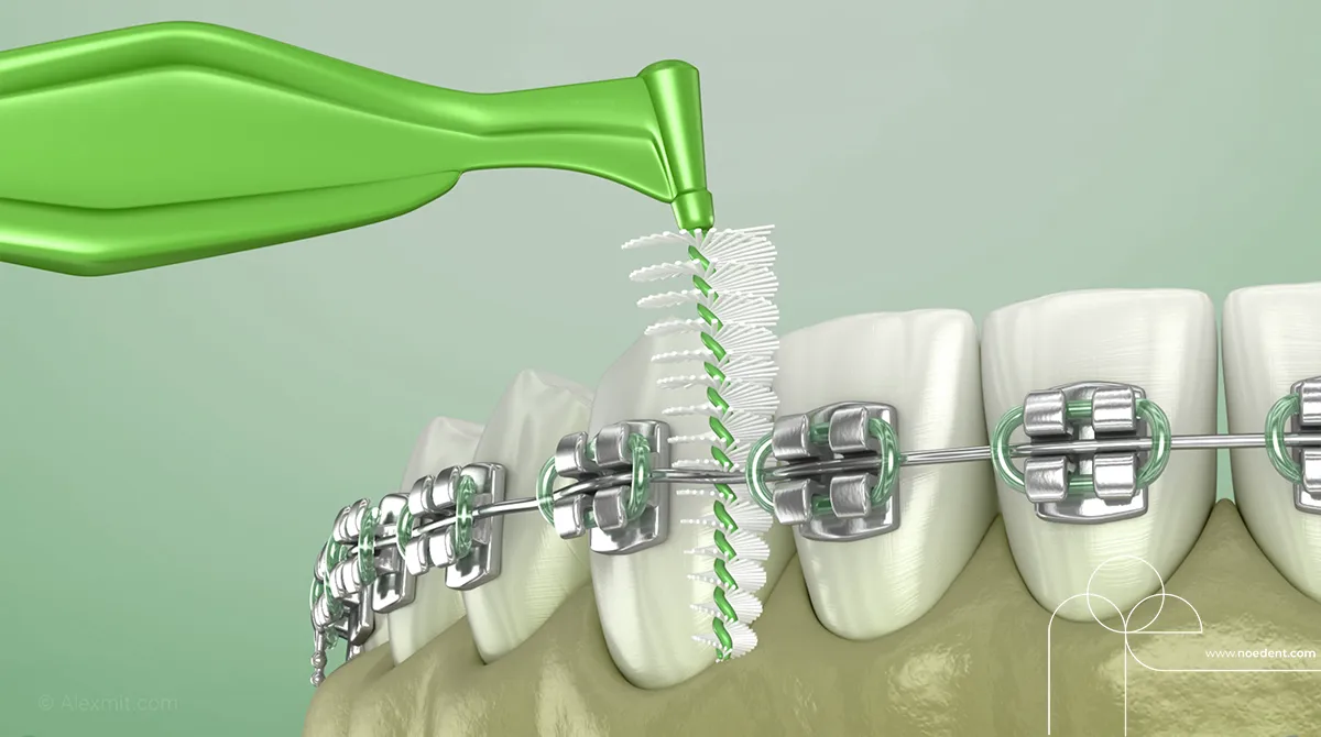 Ortodontik Ağız Bakımı , ortodontide ağız bakımı , ortodonti bilkent , ortodonti çankaya , ortodontist çankaya , Noedent Diş Kliniği