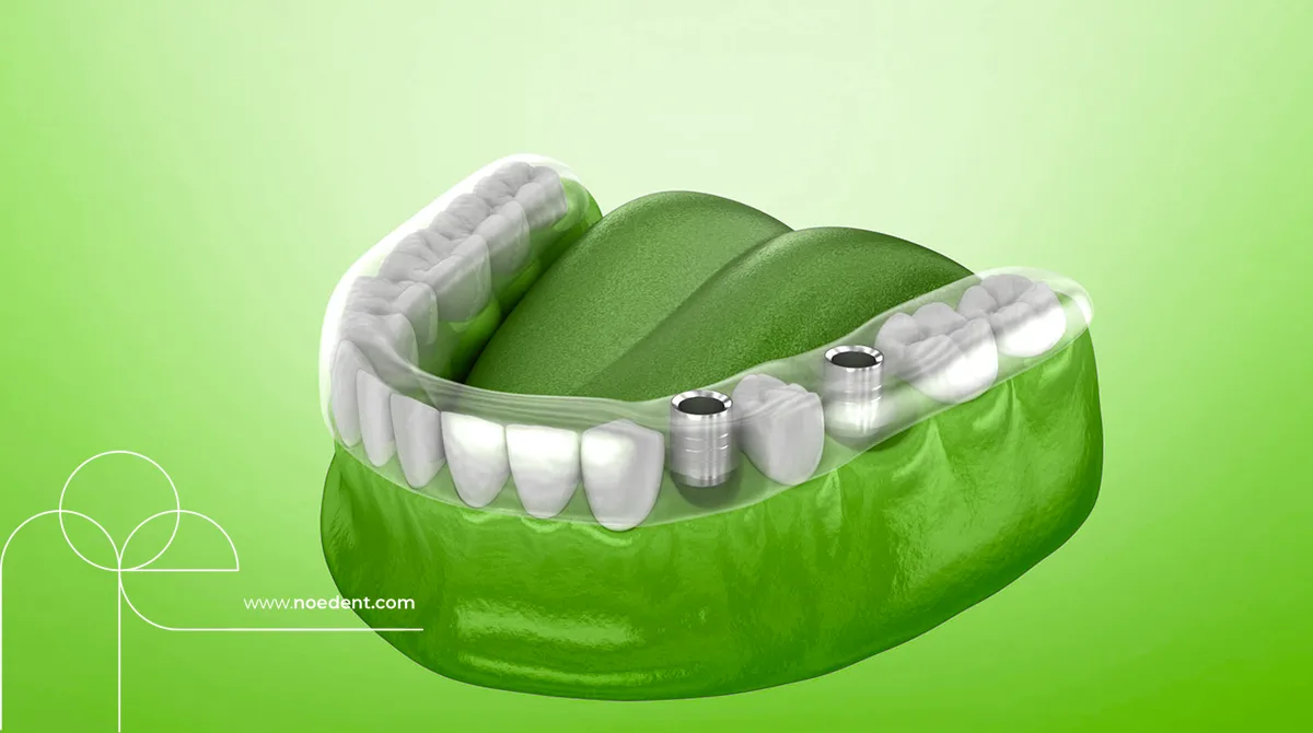 Dikişsiz İmplant , Kanamasız İmplant , Noedent Diş Kliniği