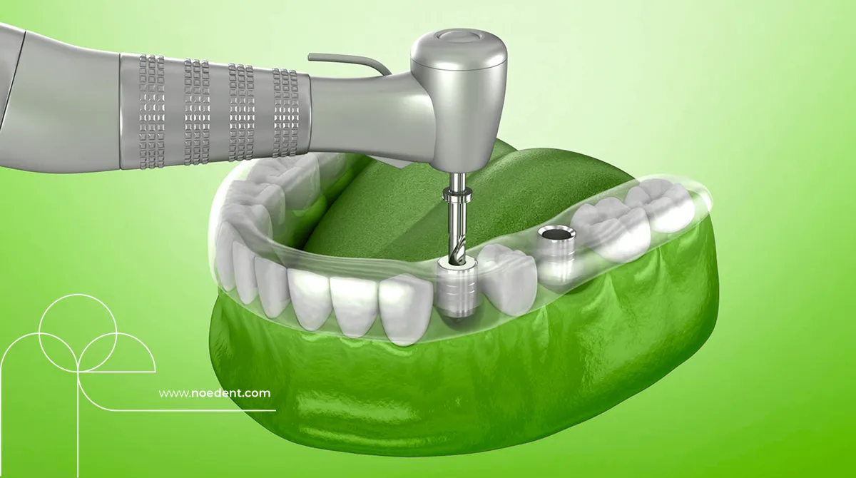 Dikişsiz İmplant , Kanamasız İmplant , Noedent Diş Kliniği