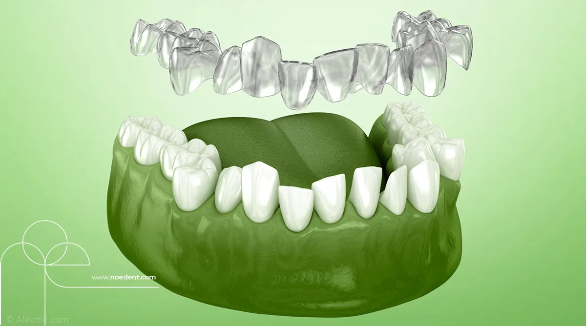 şeffaf plak tedavisi , invisalign bilkent , yetişkinlerde ortodontik tedavi, invisalign first , invisalign bilkent mustafa kemal , ortodonti bilkent , ortodontist çankaya , noedent diş kliniği , çocuklarda şeffaf plak , yetişkin ortodonti , ortodonti kliniği