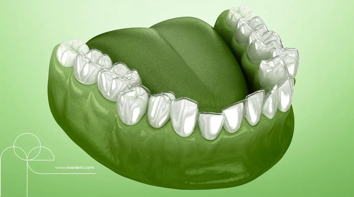 şeffaf plak tedavisi , invisalign bilkent , yetişkinlerde ortodontik tedavi, invisalign first , invisalign bilkent mustafa kemal , ortodonti bilkent , ortodontist çankaya , noedent diş kliniği , çocuklarda şeffaf plak , yetişkin ortodonti , ortodonti kliniği