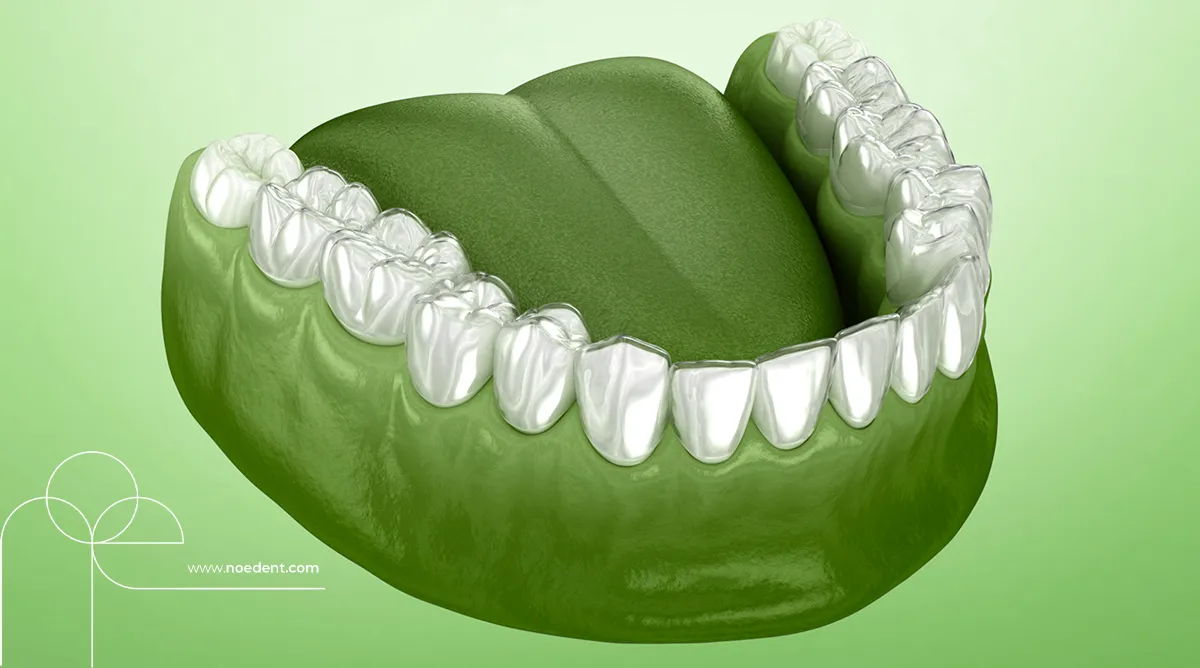 şeffaf plak tedavisi , invisalign bilkent , yetişkinlerde ortodontik tedavi, invisalign first , invisalign bilkent mustafa kemal , ortodonti bilkent , ortodontist çankaya , noedent diş kliniği , çocuklarda şeffaf plak , yetişkin ortodonti , ortodonti kliniği