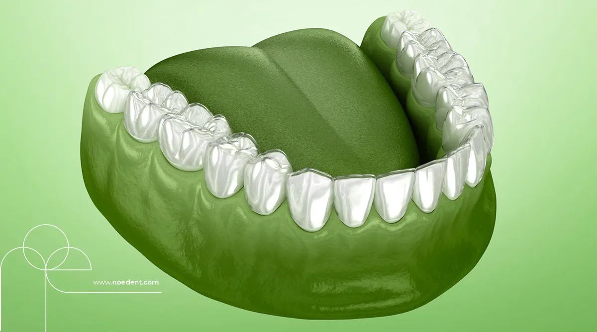 şeffaf plak tedavisi , invisalign bilkent , yetişkinlerde ortodontik tedavi, invisalign first , invisalign bilkent mustafa kemal , ortodonti bilkent , ortodontist çankaya , noedent diş kliniği , çocuklarda şeffaf plak , yetişkin ortodonti , ortodonti kliniği
