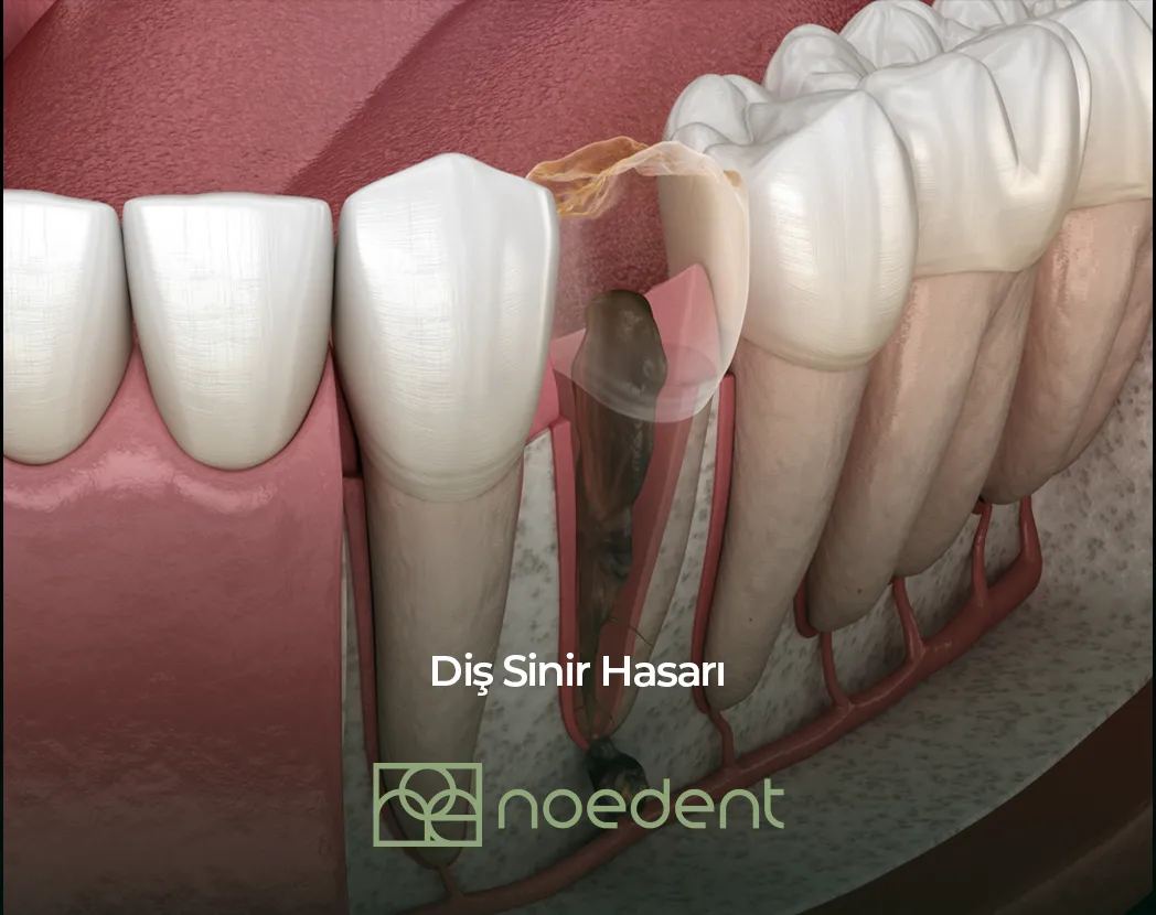 Diş Sinir Hasarı , ortodonti bilkent , ortodonti çankaya , ortodontist çankaya , çocuk diş hekimi bilkent, çocuk diş hekimi çankaya ,Noedent Diş Kliniği