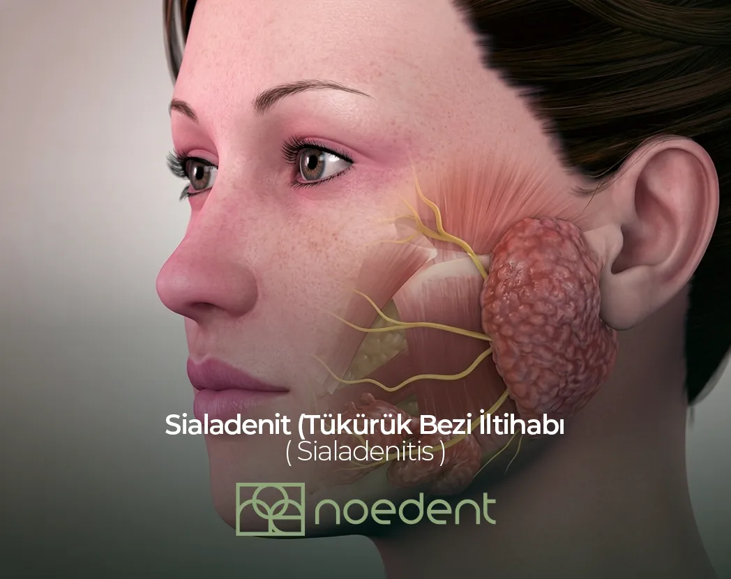 Sialadenit (Tükürük Bezi İltihabı) , ortodonti bilkent , ortodonti çankaya , ortodontist çankaya , çocuk diş hekimi bilkent, çocuk diş hekimi çankaya ,Noedent Diş Kliniği
