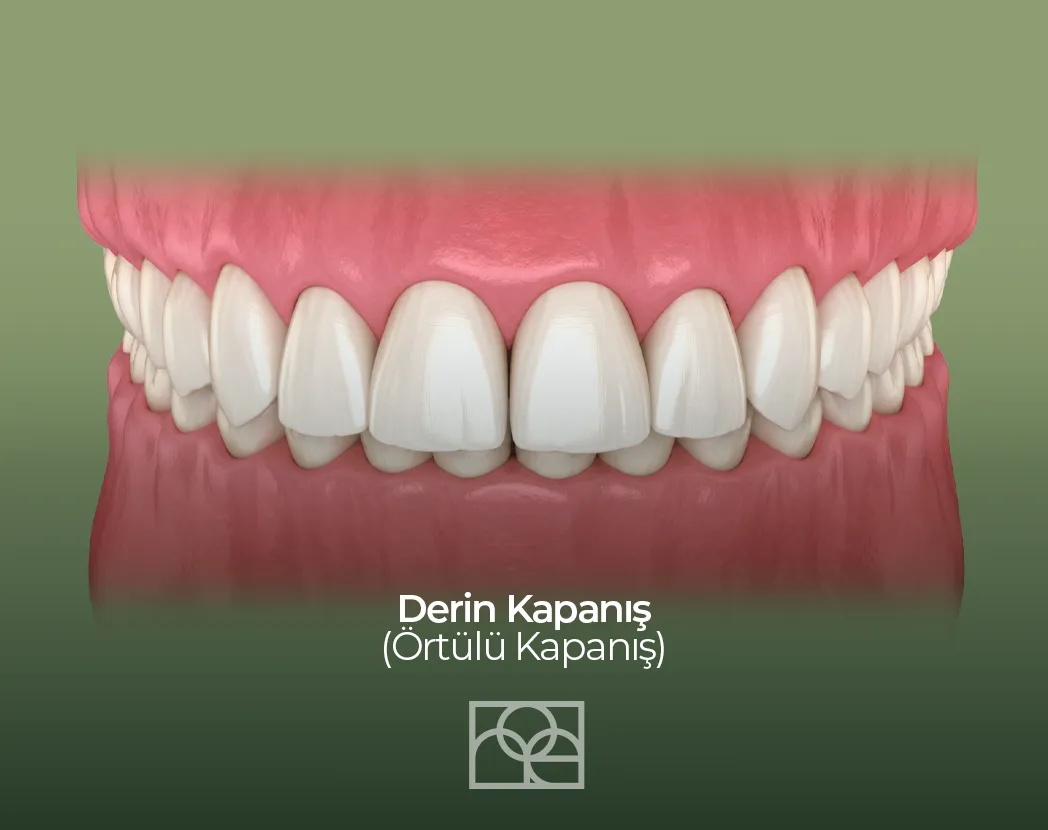derin kapanış (deep bite) nedir belirtileri ve ortodontik tedavi aşamaları