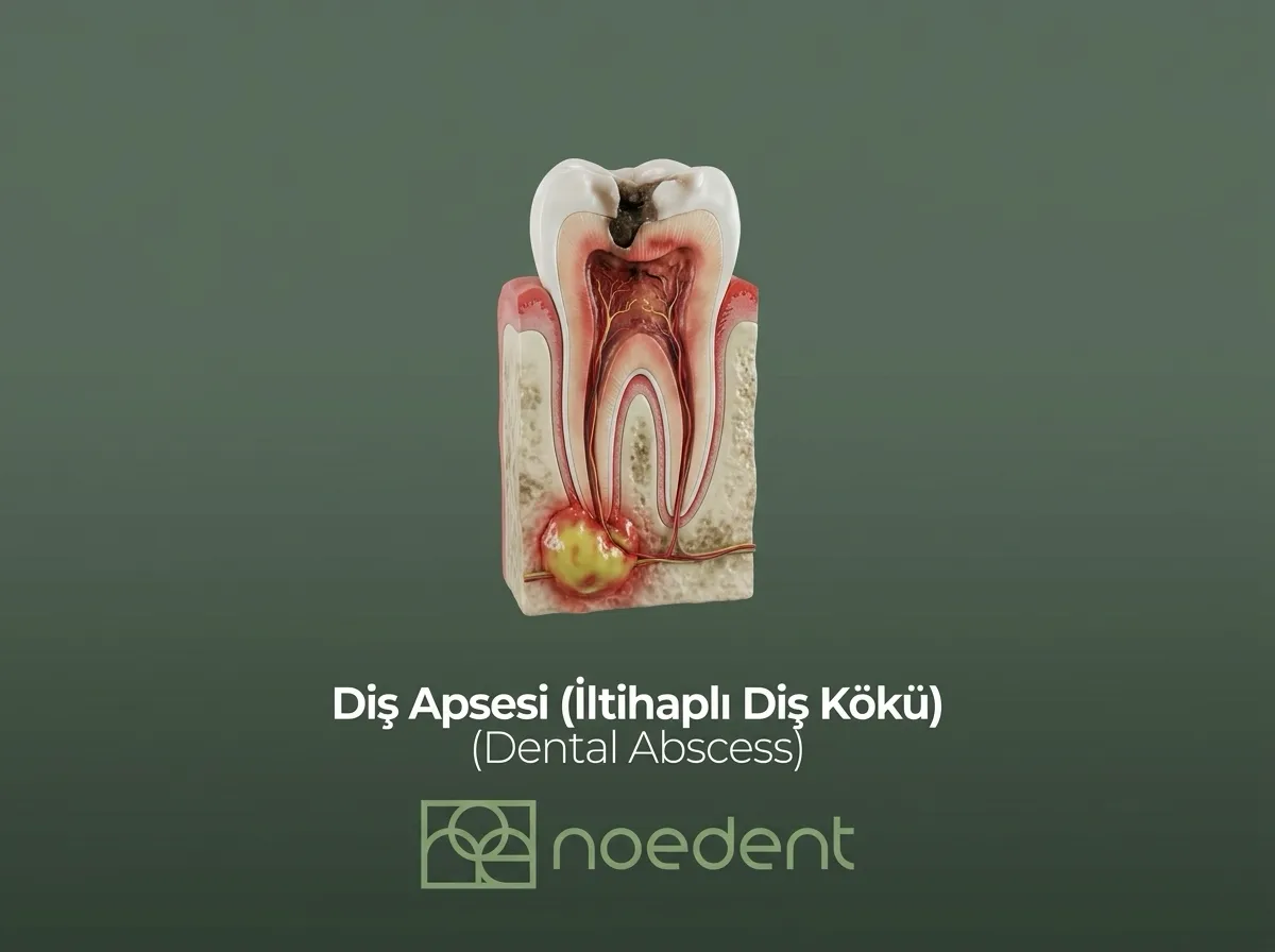Diş Apsesi (İltihaplı Diş Kökü)