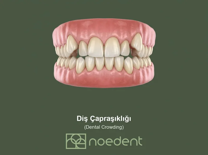 Diş Çapraşıklığı , Çapraşık Diş Tedavisi