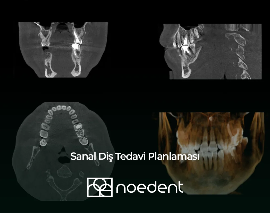 sanal diş tedavi planlaması , ortodonti bilkent , ortodonti çankaya , ortodontist çankaya , çocuk diş hekimi bilkent, çocuk diş hekimi çankaya ,Noedent Diş Kliniği