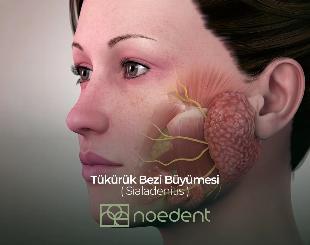 Tükürük Bezi Büyümesi , ortodonti bilkent , ortodonti çankaya , ortodontist çankaya , çocuk diş hekimi bilkent, çocuk diş hekimi çankaya ,Noedent Diş Kliniği